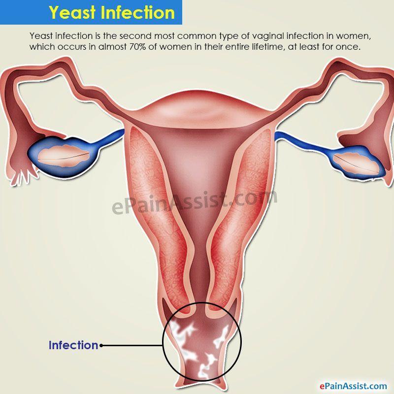 Multiple vaginal yeast infection