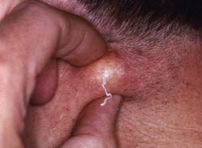 best of Cysts cause facial Can meth
