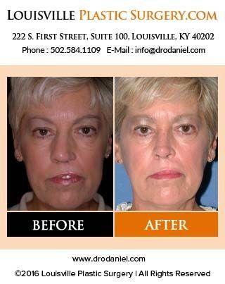 best of Plastic ky Facial surgery louisville