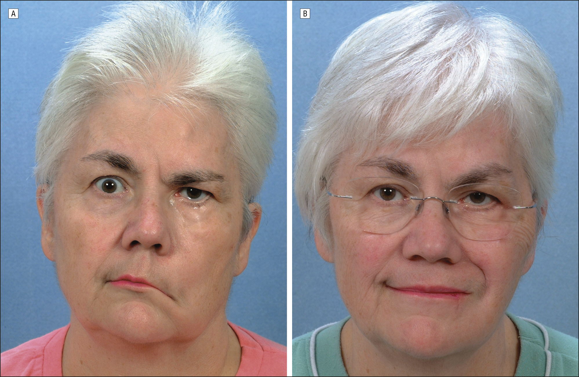 best of Synkinesis lengthening muscles Facial