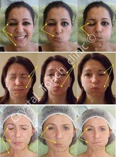 Gosling reccomend Facial synkinesis lengthening muscles