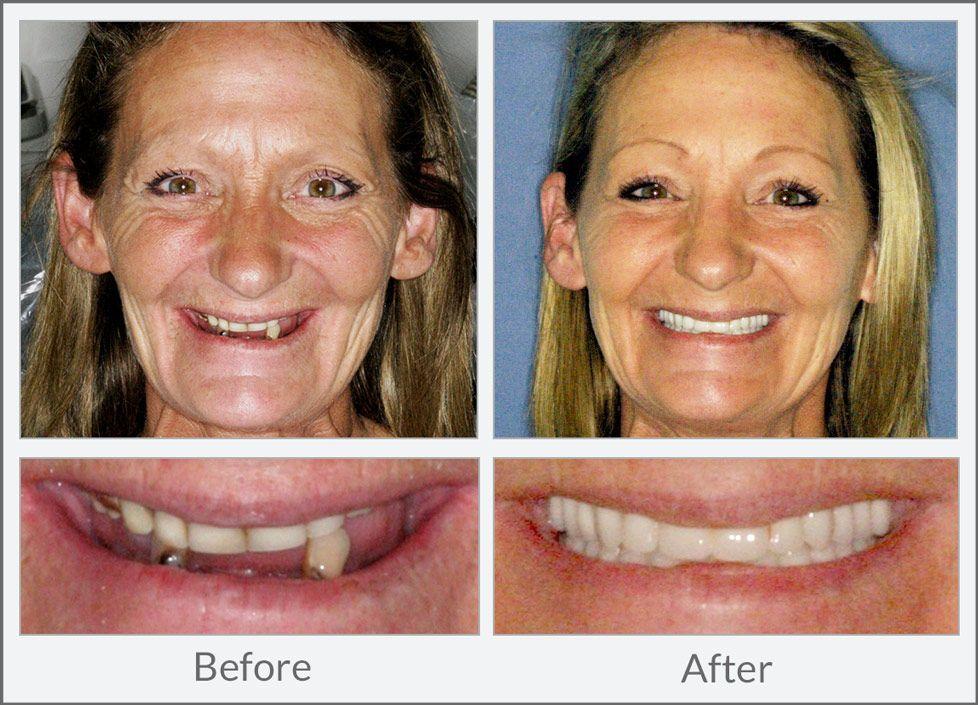 Buzz reccomend How can dentures help facial appearance