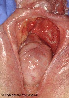 best of Of vulva of Pictures dermatitis the
