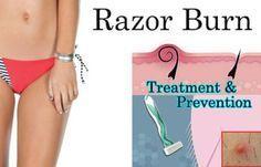 Prevent bikini razor bumps