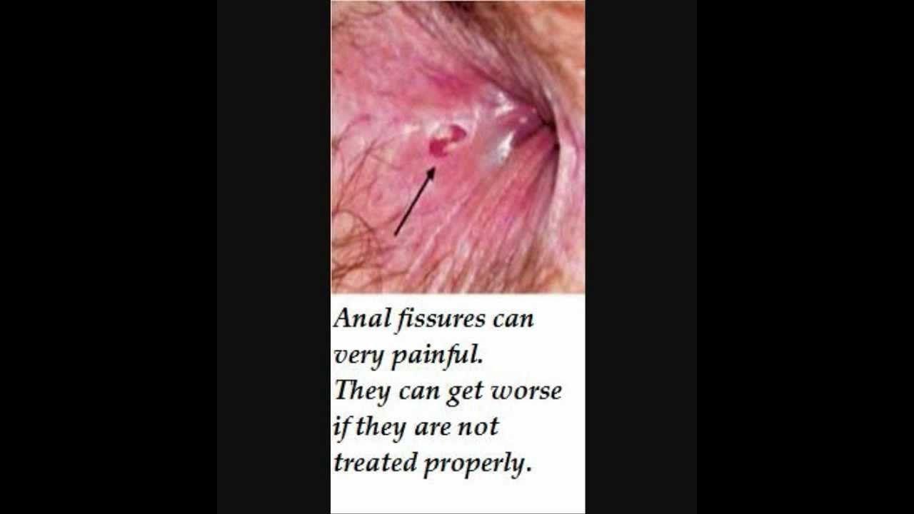 best of Pain anus sore the Skin around