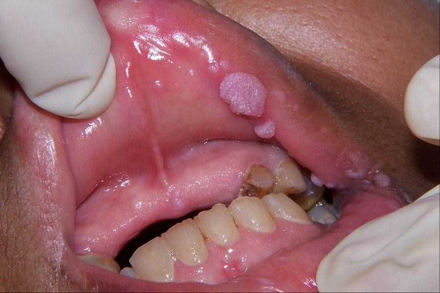 Lifesaver reccomend Sore throat gonorrhea oral sex