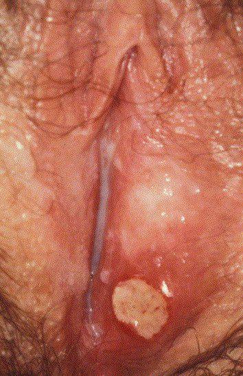 Huddle reccomend Ulcer on vulva