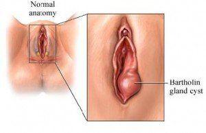 Vulva swelling after intercourse