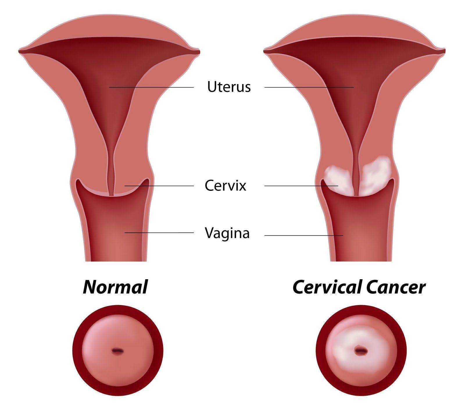 Women cervix penetration